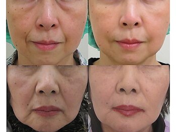 ナチュレアンドメディカ(Nature&Medica)/【たるみ改善+小顔】オンダONDA