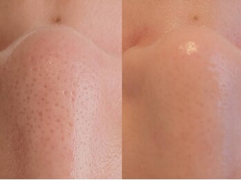 ブリリア モア(Brillia Moi)の写真/【毛穴洗浄¥4400】毛穴ごっそり大洗浄!艶やかな毛穴レス陶器肌に♪凹凸・赤ニキビもケア◎