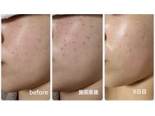 ムク(MUKU 無垢)の雰囲気（ほとんど痛みのないシミケア機で、シミを薄く綺麗に！）