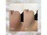【小顔ケア】韓国美容機器sonocare(リフトアップ+二重アゴ)￥5,980