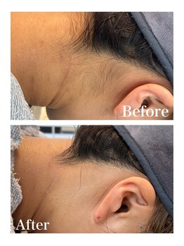 ピュア 川越店/うなじ脱毛