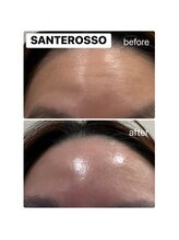 メディカル サンテロッソ(MEDICAL SANTEROSSO)/即日つやハリ実感★水光ピール