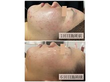 リノン(LINON)/ハーブピーリング 施術回数６回