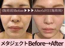 クイーンズチャーム(Queen's Charm)/メタジェクトフェイシャル★