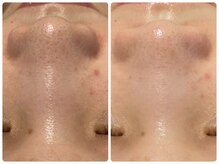 トータルビューティ ノイド(Noid)/毛穴洗浄　お試し全顔