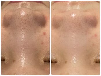 トータルビューティ ノイド(Noid)/毛穴洗浄　お試し全顔