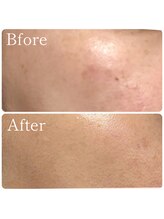 MMK/モヤっとシミにも4回で改善