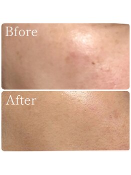 MMK/モヤっとシミにも4回で改善