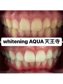 アクア 天王寺店(AQUA)/セルフホワイトニング効果