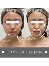 ナンバーファイブクリニカルサロン 札幌店(No.5)/BeforeAfter/小顔