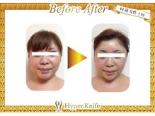 レディ 橋本/小顔効果◎