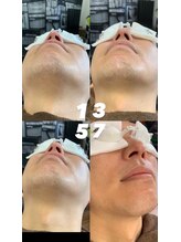 ゴールデンエイジ(Golden Age)/【ヒゲ脱毛】Before＆After