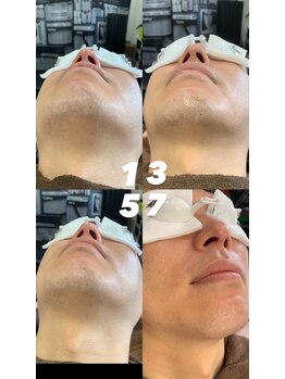 ゴールデンエイジ(Golden Age)/【ヒゲ脱毛】Before&After