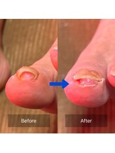 ぱんだ鍼灸接骨院 明里橋院/巻き爪施術一回目