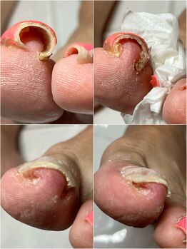 アトリエ整骨院/巻き爪補正2か所初回の施術前後