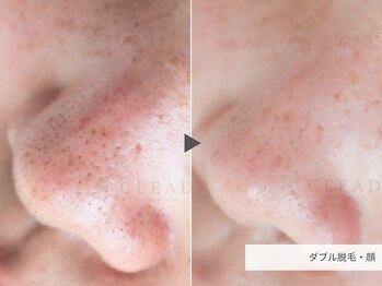 クリード(CLEAD)/フェイスワックス/顔脱毛/8000円