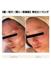 カナウ produced by きょうわ整体院(Kanau.)/赤みを抑えてなめらか肌へ