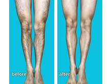 柏ベルミーランド/脱毛before→after