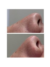 39 beauty salon.横浜関内【WAX脱毛/メンズ眉毛/水素吸入しながら】/フェイシャルワックス