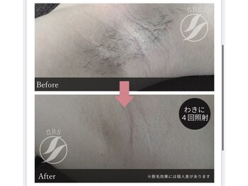 イー(iii)/ワキ脱毛効果