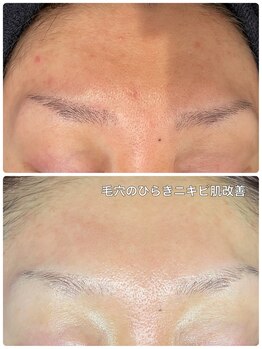 ニコリ(Nicori)/ハーブピーリング