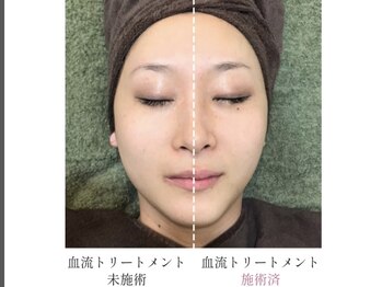 ふぁみーゆ(famille)/マイクロニードルピーリング