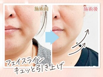 ひかりやワイワイプラザ/フェイスラインが引き上がる