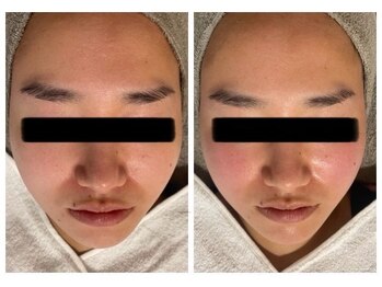 ルポアミ 代々木上原(REPOS AMI)/ヘッドスパ×小顔矯正 1回の変化