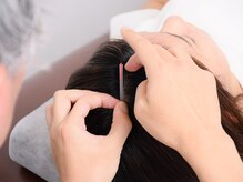 つくし鍼灸整骨院の雰囲気（はりを使った自律神経調整も行っております）