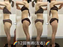 サロンドココ(Salon de COCO)/ハイパーナイフ/全身痩身/美姿勢