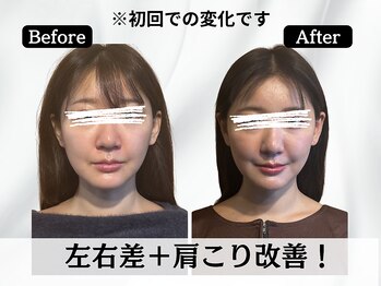 ハリユナイテッド 原宿鍼灸 整体院(HALI UNITED)/左右差なく肩こりも改善!