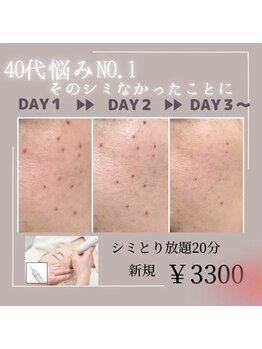 マヴィ 香里園店(MavY.)/シミケアしませんか