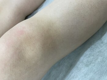 ナノハナ/鹿沼市の全身脱毛美容室ナノハナ