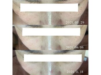 ブランシェ 富山店 × 椿/シミケア 『40代お客様』