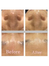 ベリル 金町店(Beryl)/毛穴洗浄＋光フェイシャル