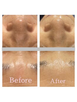 ベリル 金町店(Beryl)/毛穴洗浄＋光フェイシャル