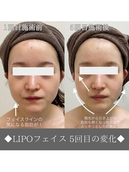 ナンバーファイブクリニカルサロン 札幌店(No.5)/BeforeAfter/リフトアップ&美白