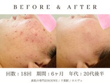 ロエヴェ(ROEWE)/ニキビ改善・毛穴ケア・肌質改善