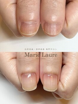マリーロール 天王寺店(Marie Laure)/深爪矯正/自爪育成/ネイルケア