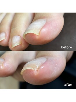 リリ(lili)/巻き爪矯正1回目(右親指)