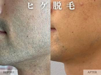 レヴェリー 心斎橋店(REVERIE)/‐ ヒゲ脱毛の症例 ‐