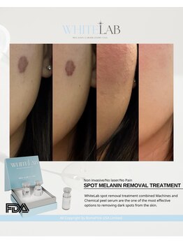 ツキ(TSUKI)/シミケア