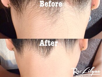 リリアック(Re:Lilyac)/Re:ilyac#全身脱毛#顔脱毛