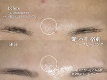 コウル 川西能勢口店(geoul)/肌質改善コース4回