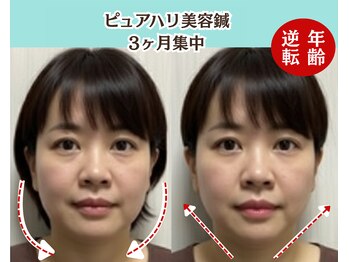 ピュアハリ/沖縄美容鍼/たるみ/効果