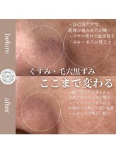 ユーアンドハニー(U&Honey.)/くすみ、毛穴が変わる美白ケア