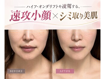 エクラ 六本木(eclat)の写真/【ほうれい線・たるみ・毛穴落ち】プラズマor高圧ニードルレス◇ほうれい線・たるみ悩み別選べる本格ケア
