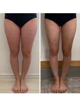 エクシア(EXCIA)/Before&After 2