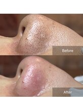 癒える(ielu)/毛穴エクストラクションBA★