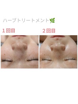 ラトゥール(Latour)/ハーブトリートメント